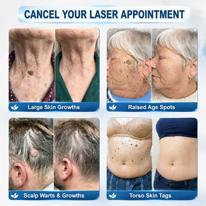 ✨Evolvion® 𝟕-𝐃𝒂𝘆 𝐒𝗸𝐢𝐧 𝐓𝒂𝗴 & 𝐒𝐩𝙤𝐭 𝐄𝐫𝒂𝐬𝙚𝐫 Painless & Scar-Free Advanced Imperfection Remova𝗜 Ro𝗜𝗜erba𝗜𝗜 Pen 🌿