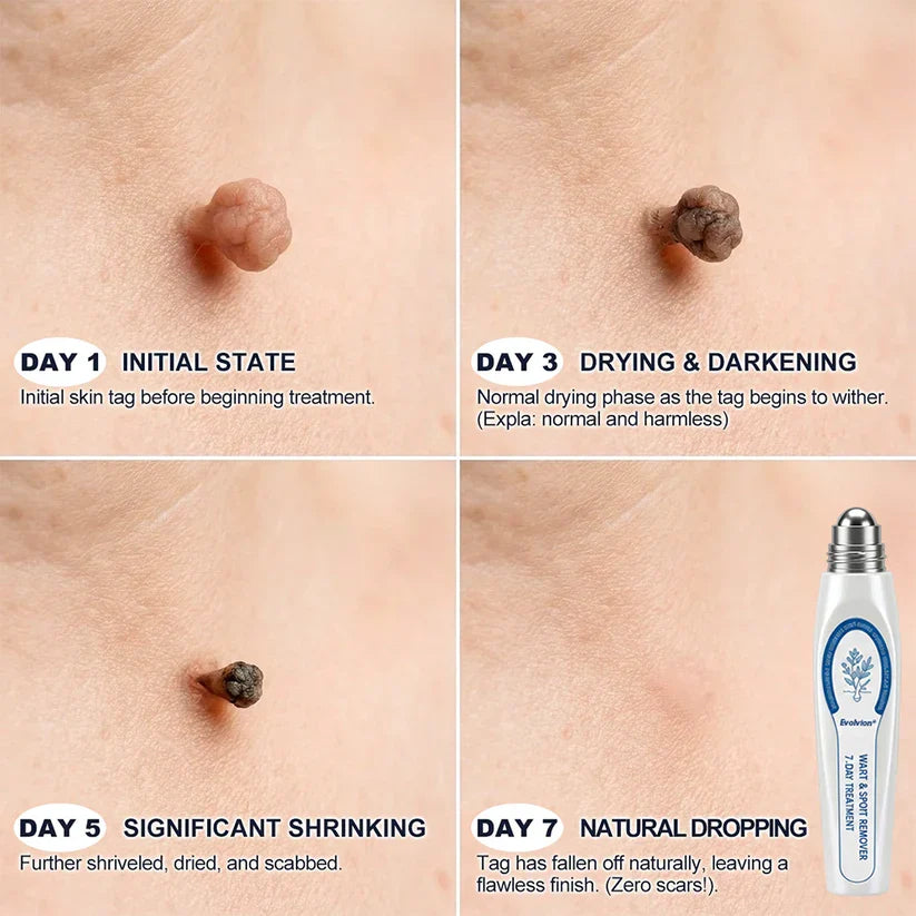 ✨Evolvion® 𝟕-𝐃𝒂𝘆 𝐒𝗸𝐢𝐧 𝐓𝒂𝗴 & 𝐒𝐩𝙤𝐭 𝐄𝐫𝒂𝐬𝙚𝐫 Painless & Scar-Free Advanced Imperfection Remova𝗜 Ro𝗜𝗜erba𝗜𝗜 Pen 🌿