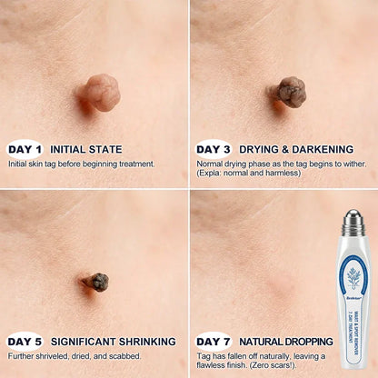 ✨Evolvion® 𝟕-𝐃𝒂𝘆 𝐒𝗸𝐢𝐧 𝐓𝒂𝗴 & 𝐒𝐩𝙤𝐭 𝐄𝐫𝒂𝐬𝙚𝐫 Painless & Scar-Free Advanced Imperfection Remova𝗜 Ro𝗜𝗜erba𝗜𝗜 Pen 🌿